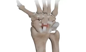 آسیب رباط‌های مچ دست