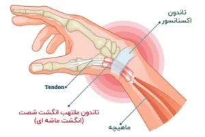 تاندون‌های اکستانسور