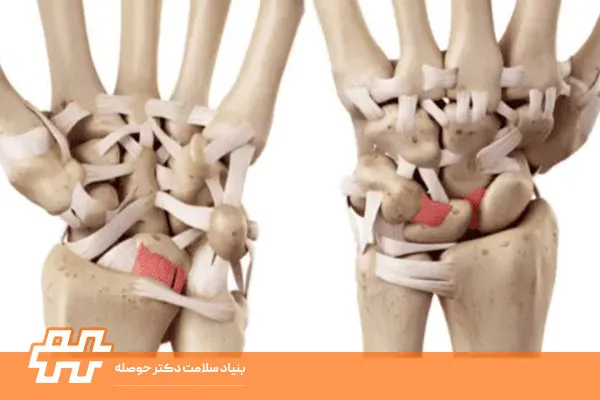 آسیب رباط‌های مچ دست