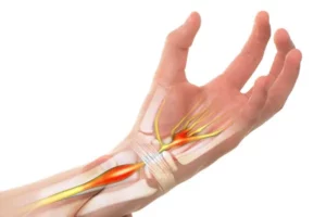 سندرم ضربه مچ دست