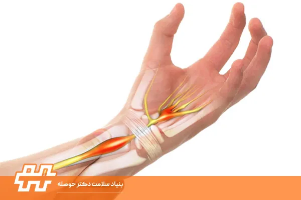 سندروم تونل کارپال