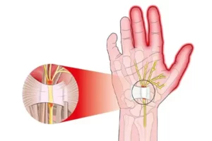 سندروم تونل کارپال