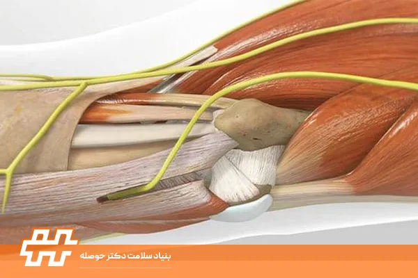 فشردگی عصبی ساعد