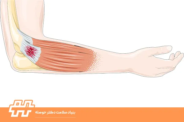 پارگی تاندون‌ها