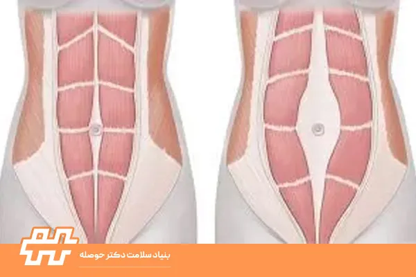 پارگی عضلات شکم