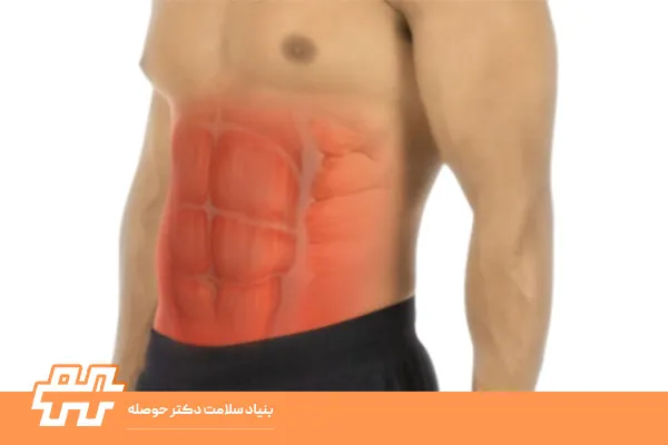 کشیدگی عضلات شکم